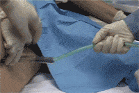 Utilizzo dell'Endosponge nel trattamento delle deiscenze anastomiche colorettali