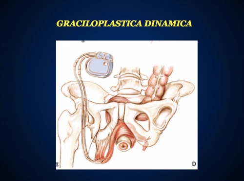 Graciloplastica Dinamica