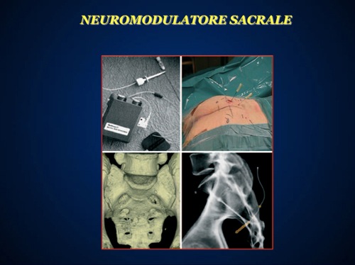 Neuromodulatore Scarale