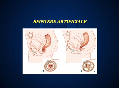 Sfintere artificiale